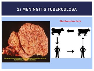 1) MENINGITIS TUBERCULOSA
Mycobacterium bovis
 