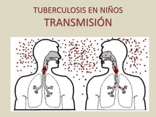 TUBERCULOSIS EN NIÑOS
TRANSMISIÓN
 