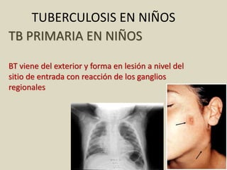 TB PRIMARIA EN NIÑOS
BT viene del exterior y forma en lesión a nivel del
sitio de entrada con reacción de los ganglios
regionales
TUBERCULOSIS EN NIÑOS
 