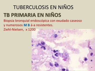 TB PRIMARIA EN NIÑOS
Biopsia bronquial endoscópica con exudado caseoso
y numerosos M B á-a resistentes.
Ziehl-Nielsen, x 1200
TUBERCULOSIS EN NIÑOS
 