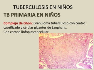 TUBERCULOSIS EN NIÑOS
TB PRIMARIA EN NIÑOS
Complejo de Ghon: Granuloma tuberculoso con centro
caseificado y células gigantes de Langhans.
Con corona linfoplasmocelular
 