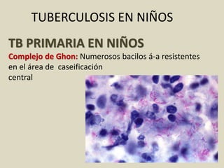 TUBERCULOSIS EN NIÑOS
TB PRIMARIA EN NIÑOS
Complejo de Ghon: Numerosos bacilos á-a resistentes
en el área de caseificación
central
 