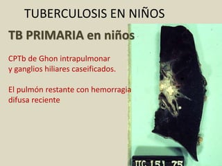 TUBERCULOSIS EN NIÑOS
TB PRIMARIA en niños
CPTb de Ghon intrapulmonar
y ganglios hiliares caseificados.
El pulmón restante con hemorragia
difusa reciente
 