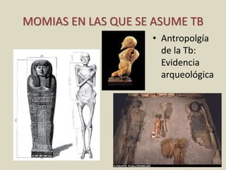 MOMIAS EN LAS QUE SE ASUME TB
• Antropolgía
de la Tb:
Evidencia
arqueológica
 