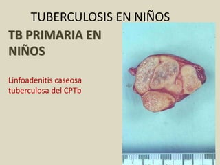 TB PRIMARIA EN
NIÑOS
Linfoadenitis caseosa
tuberculosa del CPTb
TUBERCULOSIS EN NIÑOS
 