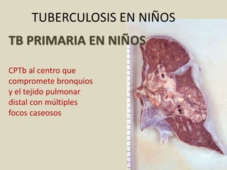 TUBERCULOSIS EN NIÑOS
TB PRIMARIA EN NIÑOS
CPTb al centro que
compromete bronquios
y el tejido pulmonar
distal con múltiples
focos caseosos
 