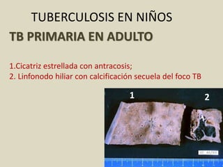 TUBERCULOSIS EN NIÑOS
TB PRIMARIA EN ADULTO
1.Cicatriz estrellada con antracosis;
2. Linfonodo hiliar con calcificación secuela del foco TB
1 2
 