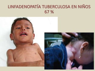 LINFADENOPATÍA TUBERCULOSA EN NIÑOS
67 %
 