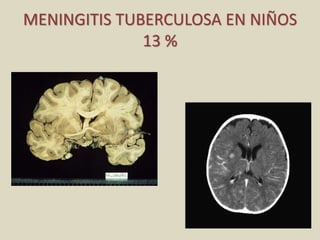 MENINGITIS TUBERCULOSA EN NIÑOS
13 %
 