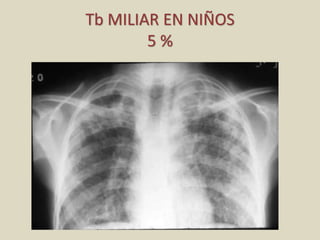 Tb MILIAR EN NIÑOS
5 %
 