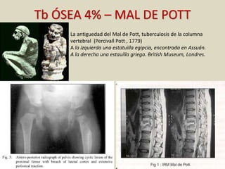 Tb ÓSEA 4% – MAL DE POTT
La antiguedad del Mal de Pott, tuberculosis de la columna
vertebral (Percivall Pott , 1779)
A la izquierda una estatuilla egipcia, encontrada en Assuán.
A la derecha una estauilla griega. British Museum, Londres.
 
