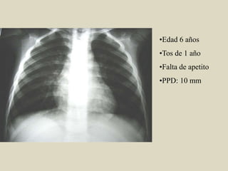 •Edad 6 años
•Tos de 1 año
•Falta de apetito
•PPD: 10 mm
 