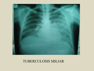 TUBERCULOSIS MILIAR
 