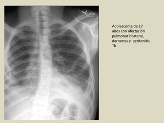 Adolescente de 17
años con afectación
pulmonar bilateral,
derrames y peritonitis
Tb
 