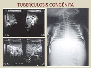 TUBERCULOSIS CONGÉNITA
 