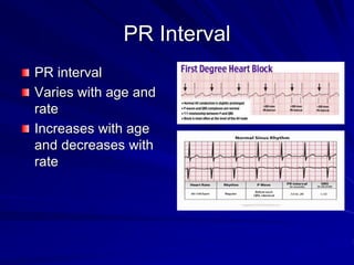 PR Interval
PR interval
Varies with age and
rate
Increases with age
and decreases with
rate
 