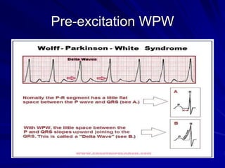 Pre-excitation WPW
 