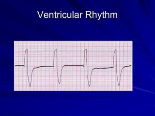Ventricular Rhythm
 