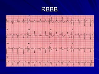 RBBB
 