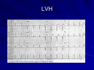 LVH
 