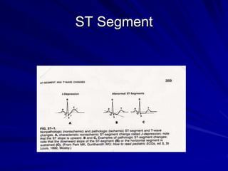 ST Segment
 