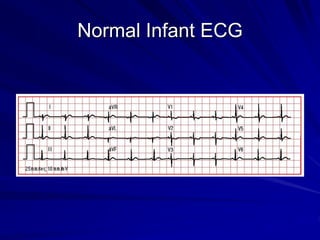 Normal Infant ECG
 
