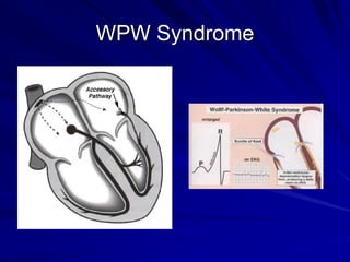 WPW Syndrome
 