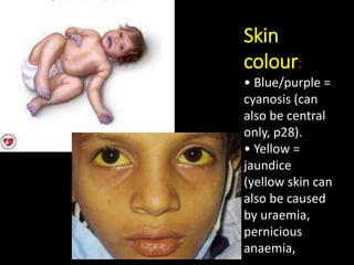 Skin
colour:
• Blue/purple =
cyanosis (can
also be central
only, p28).
• Yellow =
jaundice
(yellow skin can
also be caused
by uraemia,
pernicious
anaemia,
 