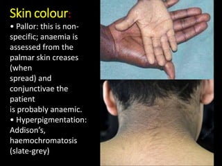 Skin colour:
• Pallor: this is non-
specific; anaemia is
assessed from the
palmar skin creases
(when
spread) and
conjunctivae the
patient
is probably anaemic.
• Hyperpigmentation:
Addison’s,
haemochromatosis
(slate-grey)
 