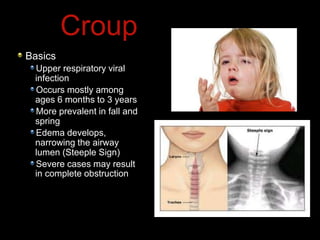 Basics
Upper respiratory viral
infection
Occurs mostly among
ages 6 months to 3 years
More prevalent in fall and
spring
Edema develops,
narrowing the airway
lumen (Steeple Sign)
Severe cases may result
in complete obstruction
Croup
 