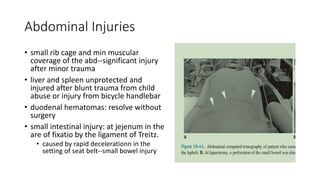 Abdominal Injuries
• small rib cage and min muscular
coverage of the abd--significant injury
after minor trauma
• liver and spleen unprotected and
injured after blunt trauma from child
abuse or injury from bicycle handlebar
• duodenal hematomas: resolve without
surgery
• small intestinal injury: at jejenum in the
are of fixatio by the ligament of Treitz.
• caused by rapid decelerationn in the
setting of seat belt--small bowel injury
 