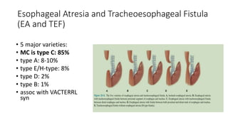 Esophageal Atresia and Tracheoesophageal Fistula
(EA and TEF)
• 5 major varieties:
• MC is type C: 85%
• type A: 8-10%
• type E/H-type: 8%
• type D: 2%
• type B: 1%
• assoc with VACTERRL
syn
 