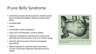 Prune Belly Syndrome
• extremely lax lower abd musculature, dilated urinary
tract including the bladder, bilateral undescended
testes
• wrinkled AAW
• males
• comorbidity: pulmo hypoplasia
• major GUT manifestation: ureteral dilation
• bilateral orchidopexy is performed in conjunction
with abd wall reconstruction at 6 to 12 months of age
• infertility (def of prostatic fluid and retrograde
ejaculation)
• abdominoplasty for abd wall repair (transverse
incision in the lower abdomen extending into the
flanks)
 