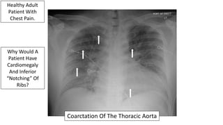 Why Would A
Patient Have
Cardiomegaly
And Inferior
“Notching” Of
Ribs?
Coarctation Of The Thoracic Aorta
Healthy Adult
Pat...