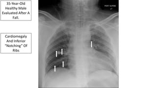 35-Year-Old
Healthy Male
Evaluated After A
Fall.
Cardiomegaly
And Inferior
“Notching” Of
Ribs
 