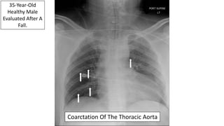 35-Year-Old
Healthy Male
Evaluated After A
Fall.
Coarctation Of The Thoracic Aorta
 