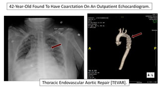 42-Year-Old Found To Have Coarctation On An Outpatient Echocardiogram.
Thoracic Endovascular Aortic Repair [TEVAR].
 