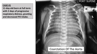 Coarctation Of The Aorta
CASE #1
11-day-old born at full term
with 2 days of progressive
respiratory distress, grunting
and decreased PO intake.
 