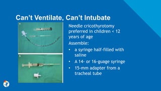 Can’t Ventilate, Can’t Intubate
Needle cricothyrotomy
preferred in children < 12
years of age
Assemble:
• a syringe half-filled with
saline
• A 14- or 16-guage syringe
• 15-mm adapter from a
tracheal tube
 