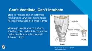 Can’t Ventilate, Can’t Intubate
Step 1: Palpate the cricothyroid
membrane: laryngeal prominence
not fully developed in child < 8yoa
Warning: Unless you’re a sharp-
shooter, this is why it is critical to
make needle cric a last resort:
2.6mm x 3mm
Photo Credit: David Low, CHOP,
www.entokey.com
 