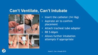 Can’t Ventilate, Can’t Intubate
• Insert the catheter (14-16g)
• Aspirate air to confirm
placement
• Attach tracheal tube adapter
• RR 5-6bpm
• Allows further intubation
attempts if appropriate
Karsli C. Can J Anesth 2015
 