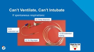 Can’t Ventilate, Can’t Intubate
If spontaneous respirations:
3) IV
extension set
2) 3-way stopcock
4) 14-16g angio
1) O2 extension
tubing
 