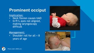 Prominent occiput
Management:
• Shoulder roll for all < 8
years of age
Implication:
• Neck flexion causes UAO
• O/P/L axes not aligned,
making laryngoscopy
difficult
Photo credit: JEMS.com,
 