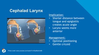 Cephalad Larynx
Implication:
• Shorter distance between
tongue and epiglottis
creates acute angle
• Larynx seems more
anterior
Management:
• Optimal positioning
• Gentle cricoid
Photo credit: www.youtube.com/watch?v=EIty86wXmB8
 