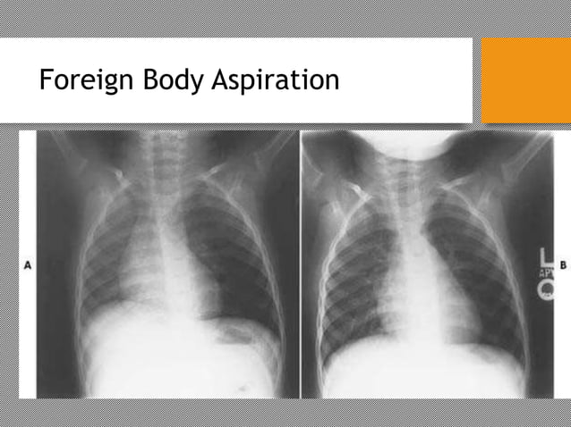 Pediatric airway foreign body | PPT | Lung and Respiratory Health ...