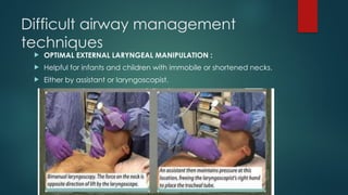 Difficult airway management
techniques
 OPTIMAL EXTERNAL LARYNGEAL MANIPULATION :
 Helpful for infants and children with immobile or shortened necks.
 Either by assistant or laryngoscopist.
 