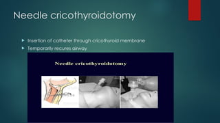 Needle cricothyroidotomy
 Insertion of catheter through cricothyroid membrane
 Temporarily recures airway
 