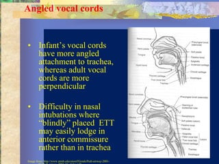 Angled vocal cords


• Infant’s vocal cords
  have more angled
  attachment to trachea,
  whereas adult vocal
  cords are more
  perpendicular

• Difficulty in nasal
  intubations where
  “blindly” placed ETT
  may easily lodge in
  anterior commissure
  rather than in trachea
Image from: http://www.utmb.edu/otoref/Grnds/Pedi-airway-2001-
 