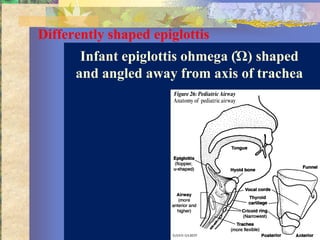 Differently shaped epiglottis
       Infant epiglottis ohmega (Ώ) shaped
      and angled away from axis of trachea
 