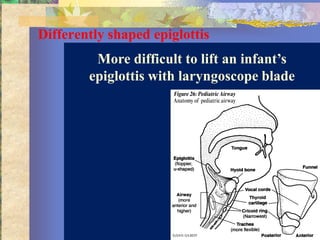 Differently shaped epiglottis
         More difficult to lift an infant’s
        epiglottis with laryngoscope blade
 